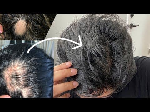 2 Year Alopecia Hair Growth Update | hair growth tips & products