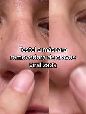 Testei a máscara de remover cravos da @LANBENA.BR , vem ver o antes e depois #mascaradecravo #removedordecravos #skincare #tiktokshopbr99